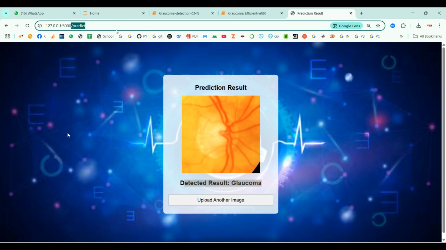 Glaucoma Detection CNN in Python Projects
