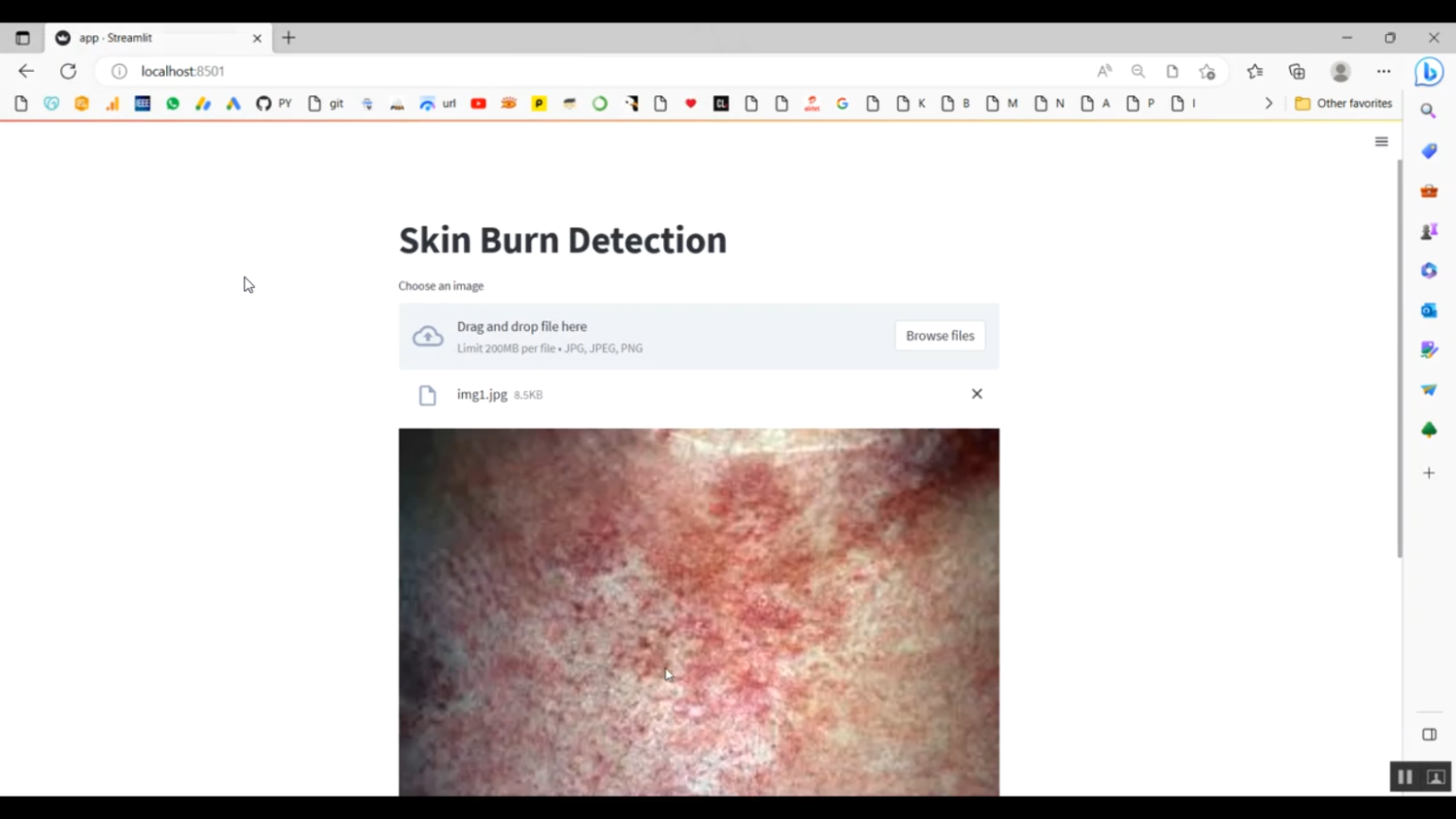 Skin Burn Image Data Flask in Python Projects