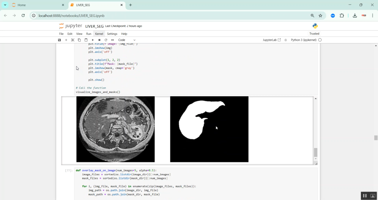 Liver Tumor Segmentation in Python Projects