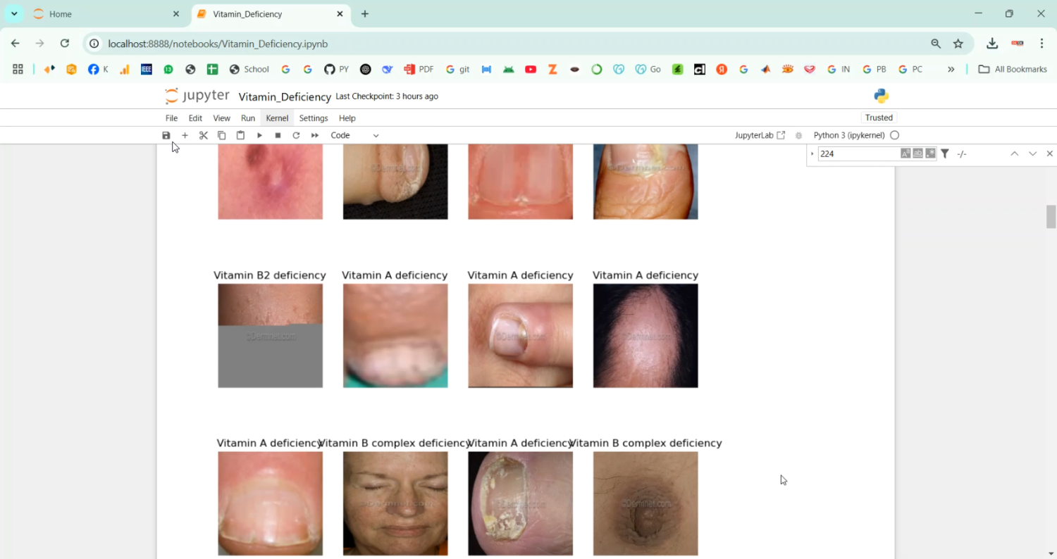 Vitamin Deficiency Detection Using Image Processing in Python Projects
